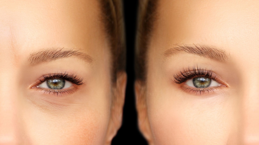 Fractional Blepharoplasma®